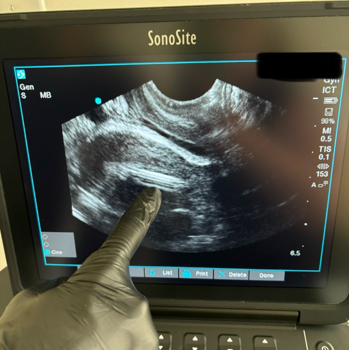 ultrasound-guided-IUD-insertions